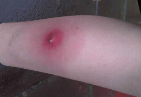 Horse Fly Bite